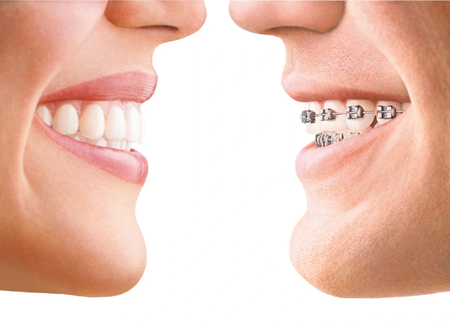 Side-by-side comparison showing natural teeth versus teeth with dental braces on white background.
