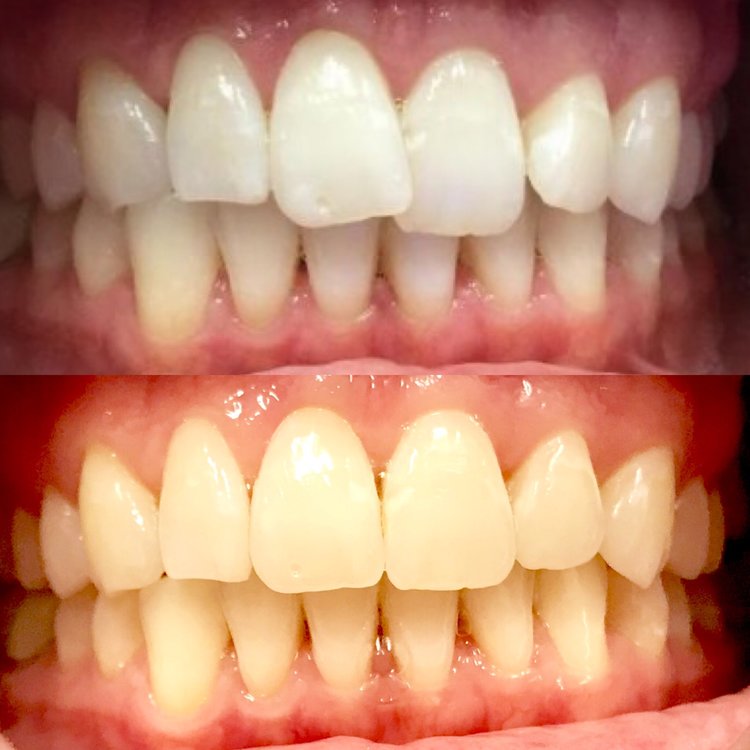 Before and after dental comparison showing whitened upper teeth versus yellowed lower teeth alignment.