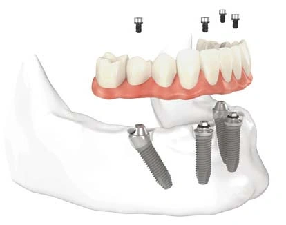 Dental implant model showing jawbone structure with prosthetic teeth and implant fixtures for educational demonstration.