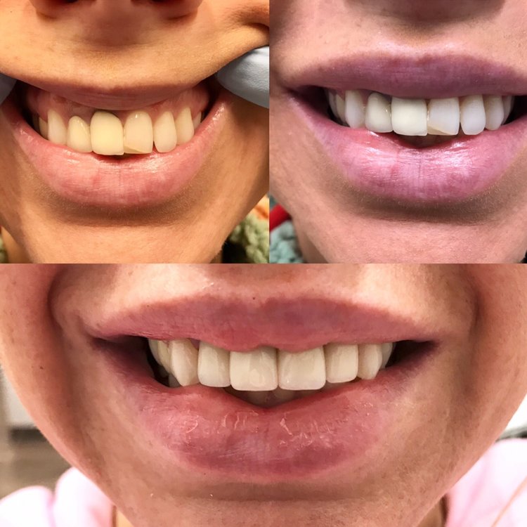 Before and after dental transformation showing teeth whitening and cosmetic improvement results.