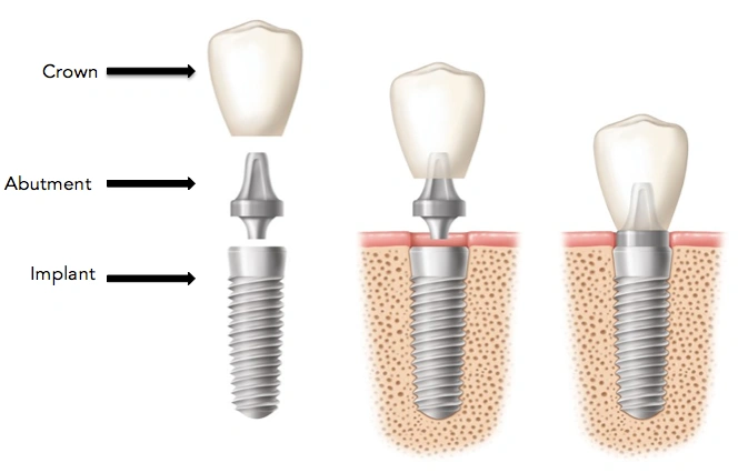Dental implant diagram showing crown, abutment, and implant components in jawbone.