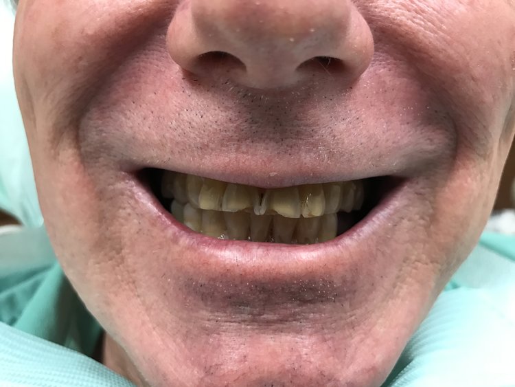 Close-up of patient's smile showing teeth and gums in dental clinical setting.