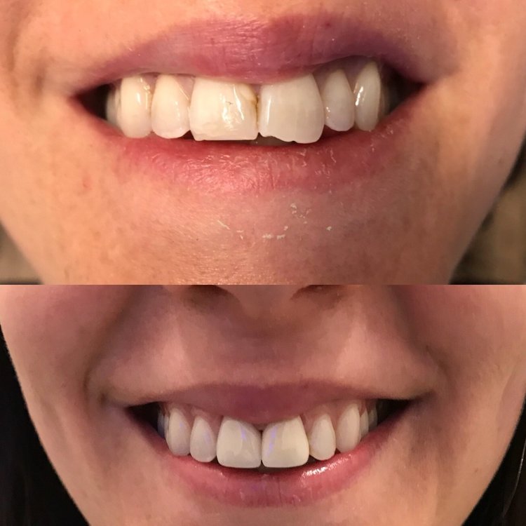 Before and after comparison of teeth whitening results showing improved tooth brightness and smile transformation.