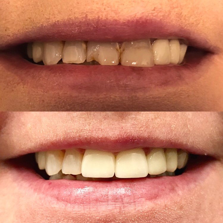 Before and after comparison of teeth whitening results showing improved brightness and shade.
