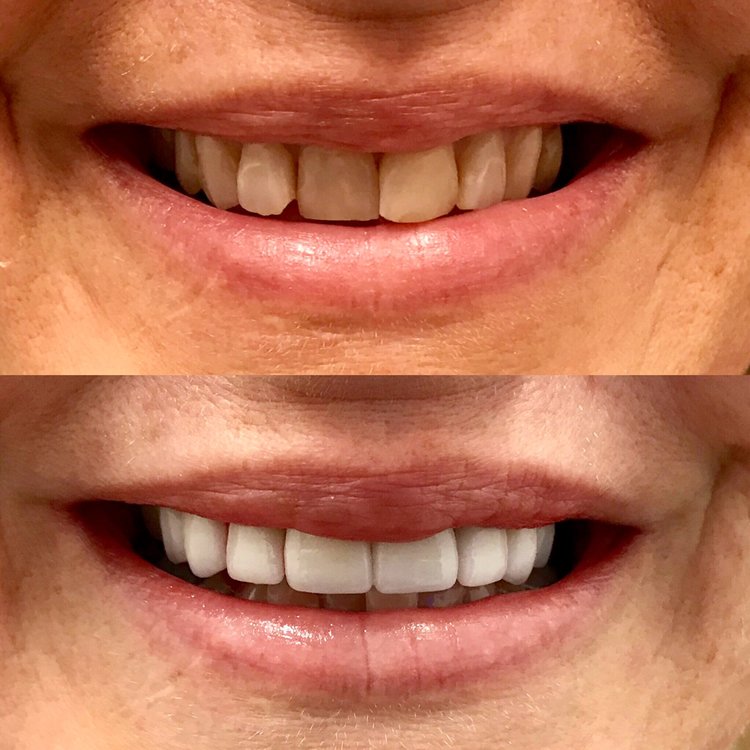 Before and after dental treatment comparison showing improved tooth appearance and smile aesthetics.