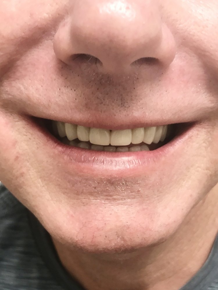 Close-up of person's smile showing teeth and lower face against neutral background.