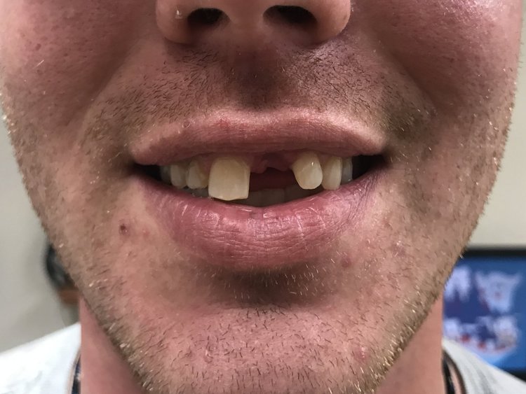 Close-up of person's smile showing missing and discolored teeth, dental treatment context.
