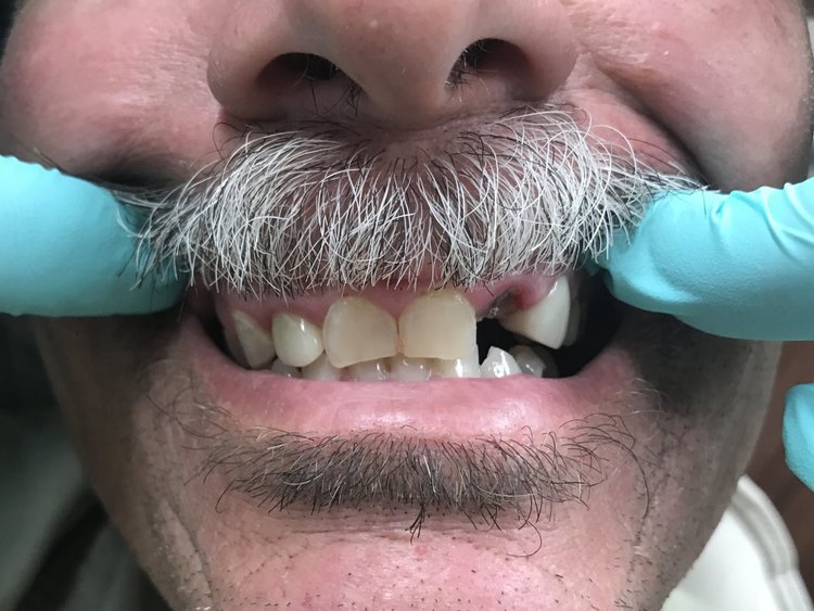 Man with gray mustache holding blue dental tools near mouth, demonstrating dental procedure or examination.