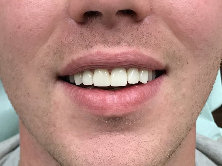 Close-up of a person's smile showing bright, evenly-aligned white teeth and healthy gums.