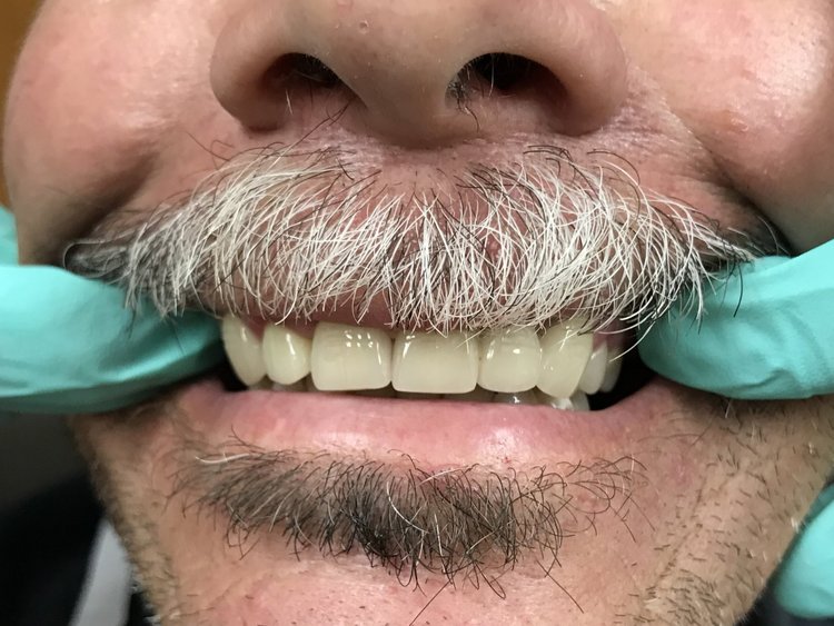 Close-up of man's smile displaying teeth with mustache and beard visible.