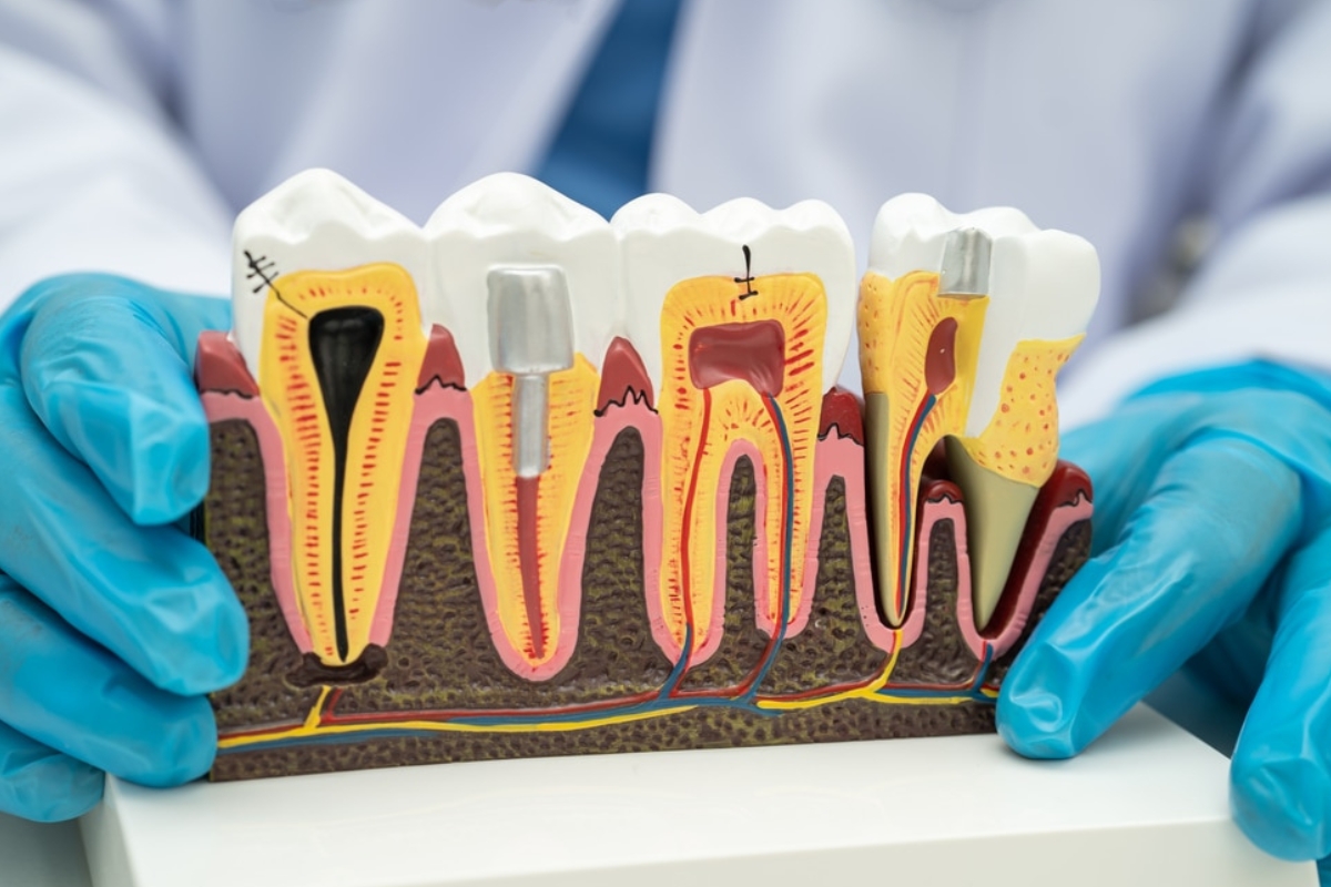 Emergency dentists for Root canal treatment in Arlington